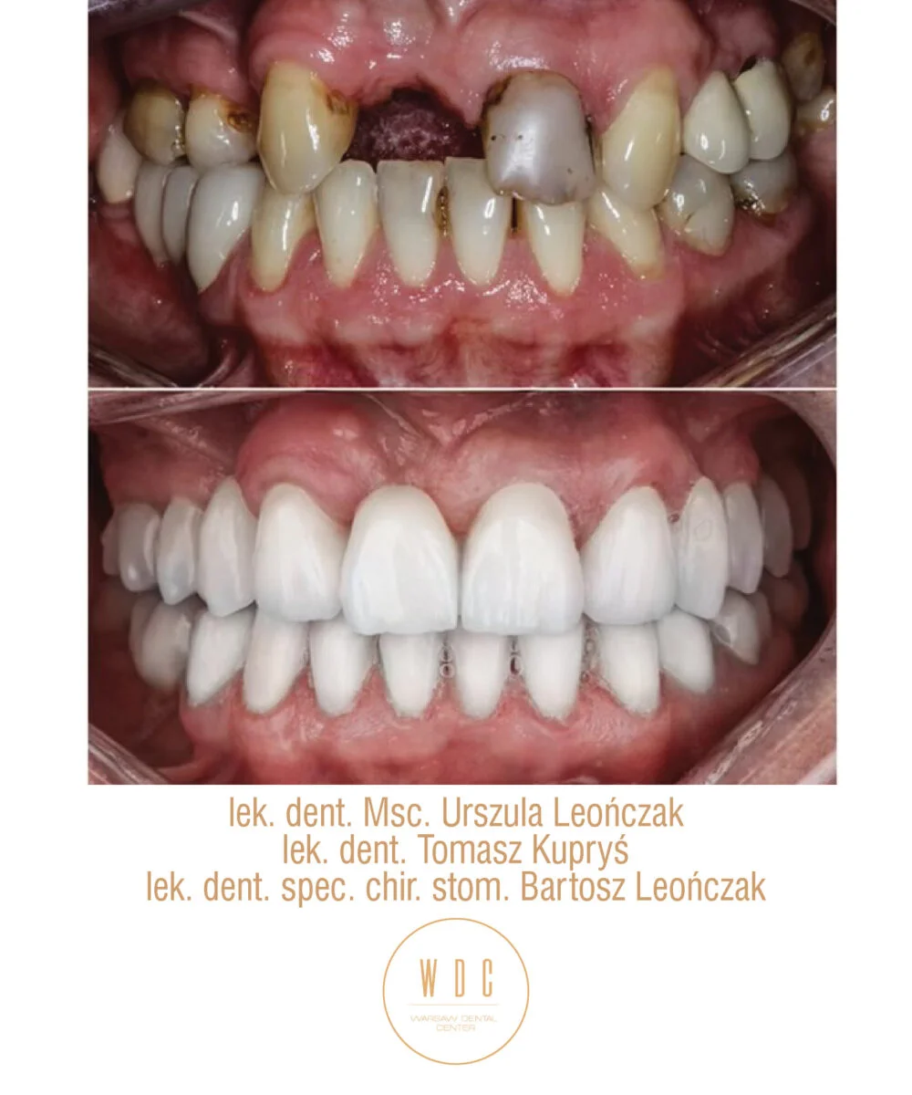 Metamorfoza-usmiechu-w-Warsaw-Dental-Center