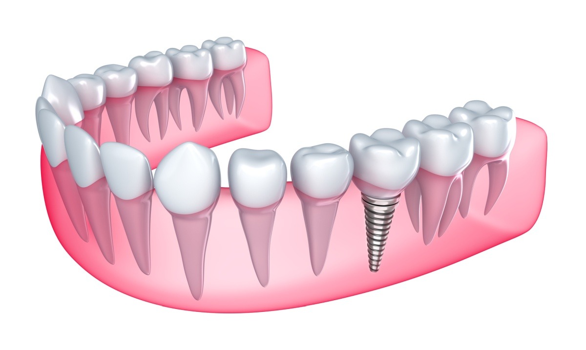 Rodzaje implantów zębowych — gwarancja komfortu i pięknego uśmiechu