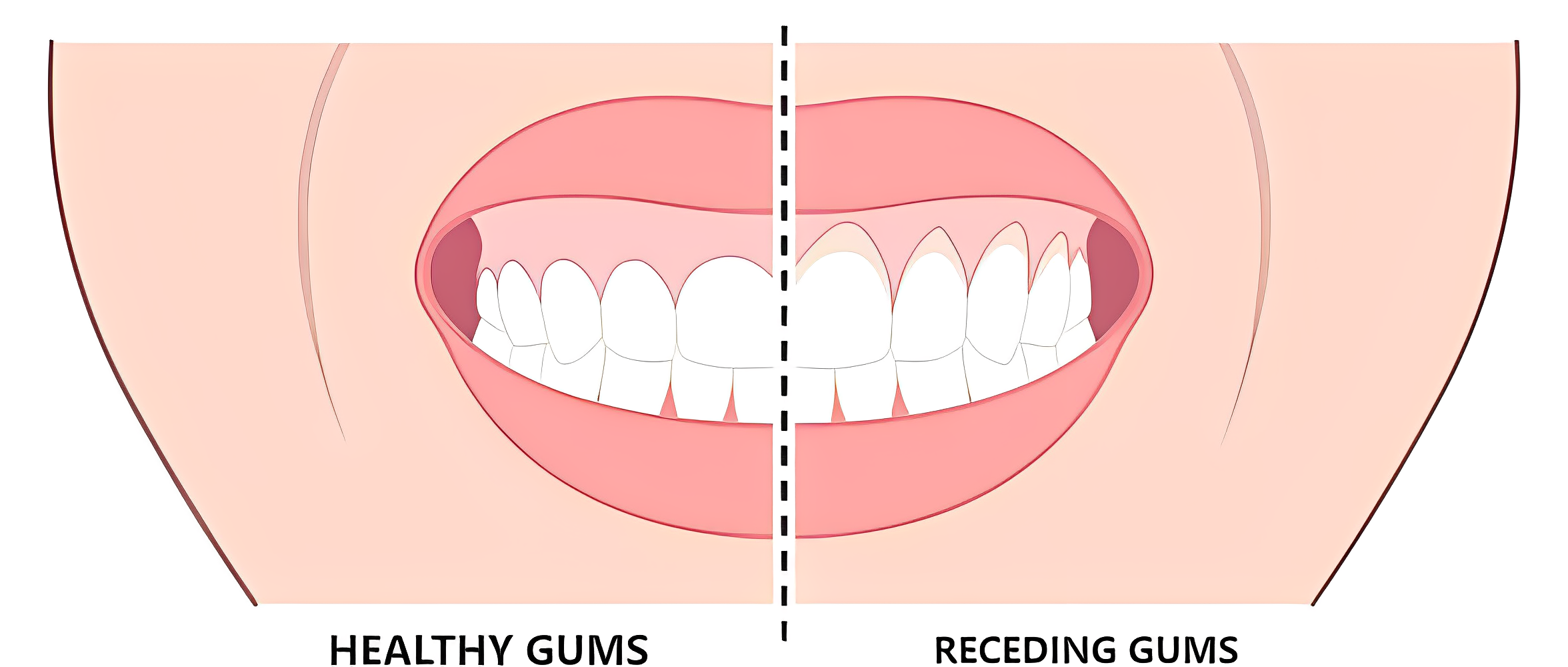 gum recession 