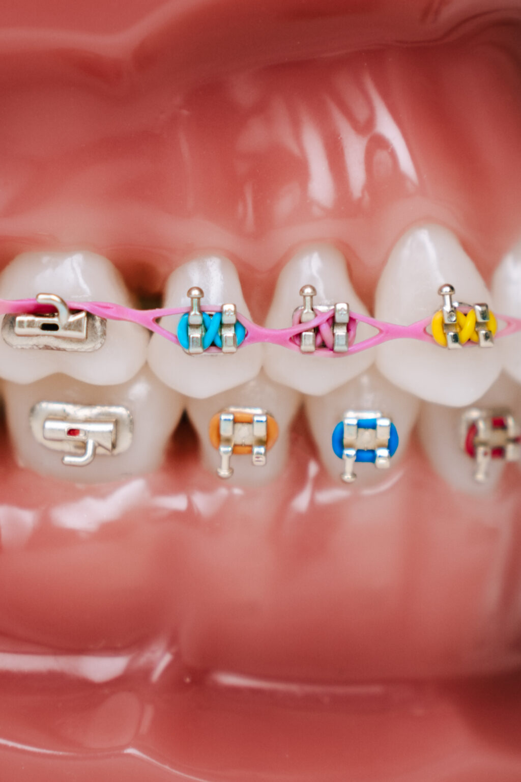 Are Rubber Bands on Braces Important?