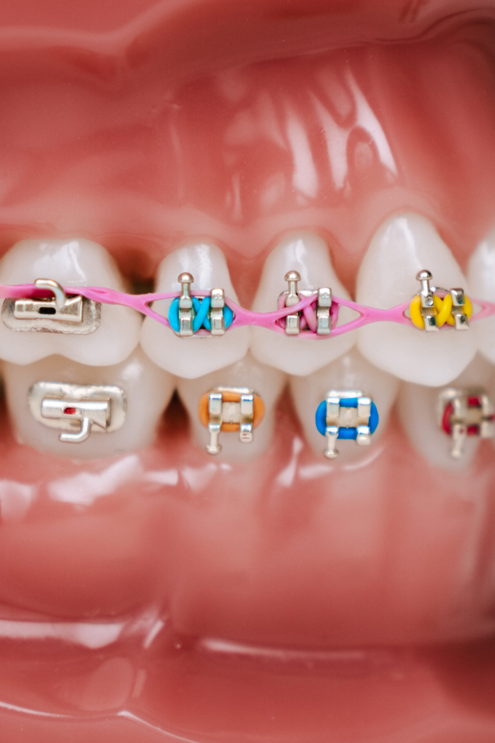 How to and why wear your elastic orthodontic bands, Elastic instructions  for braces are here