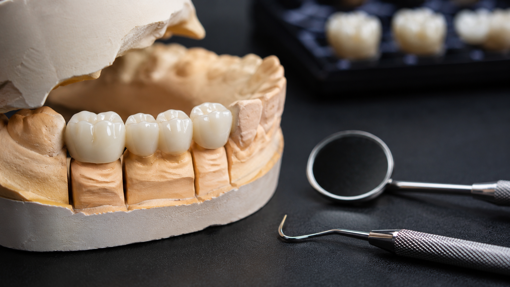 Prosthetic model with dental crowns prepared for smile reconstruction