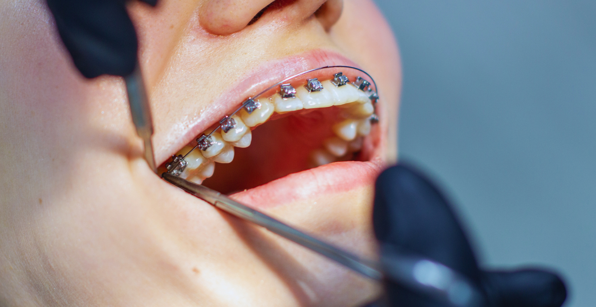 aparat ortodontyczny