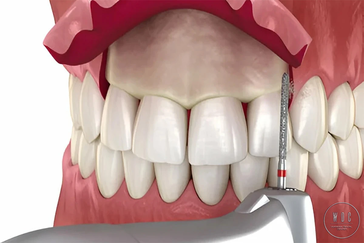 Close-up of the crown lengthening procedure, showing detailed treatment.
