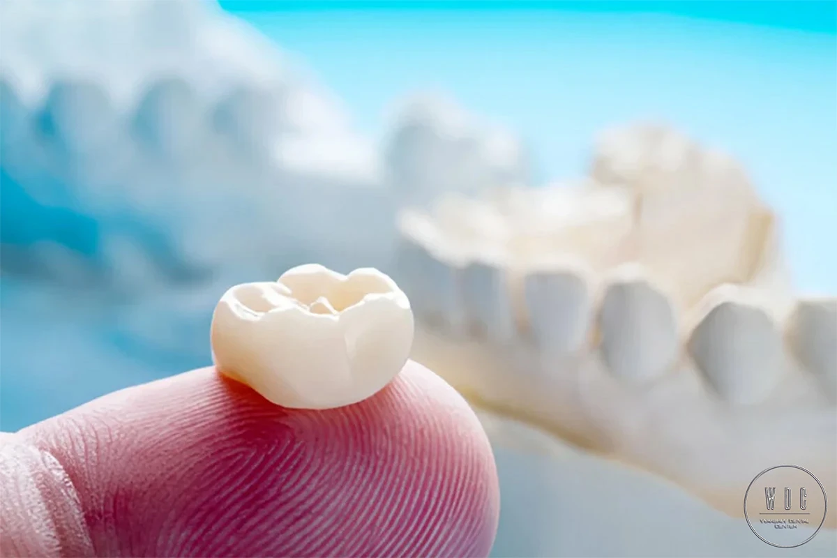 Highly aesthetic dental crown is on the index finger.