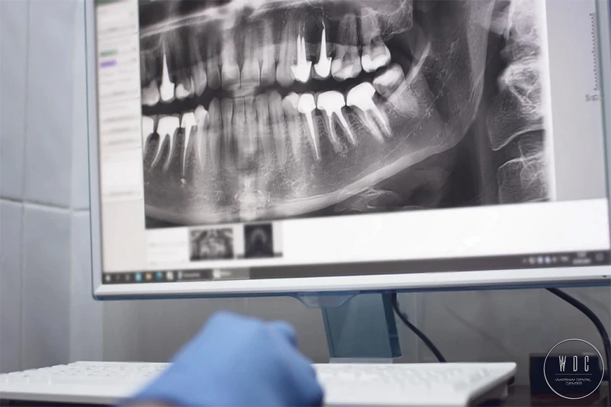 Panoramiczny obraz zębów na ekranie komputera.