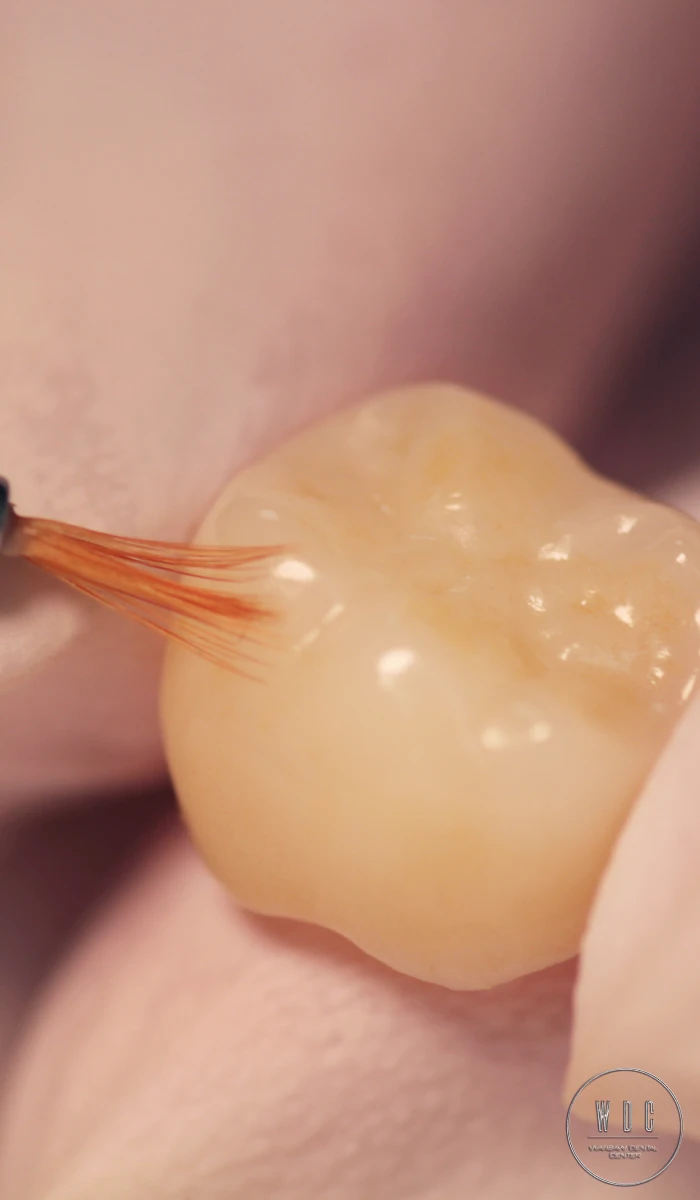 Aesthetic crown at Warsaw Dental Center