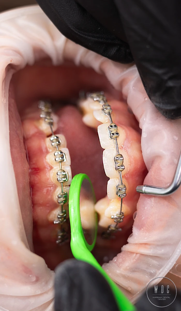 Patient receiving orthodontic treatment at Warsaw Dental Center