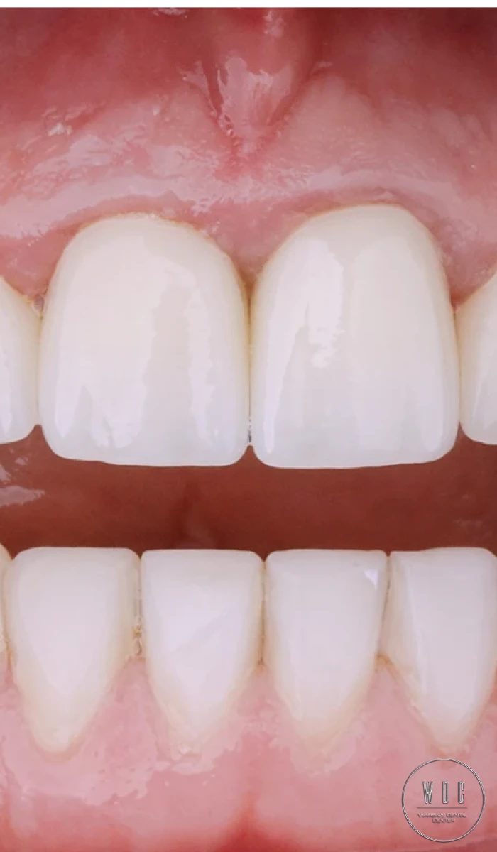 Veneers at Warsaw Dental Center