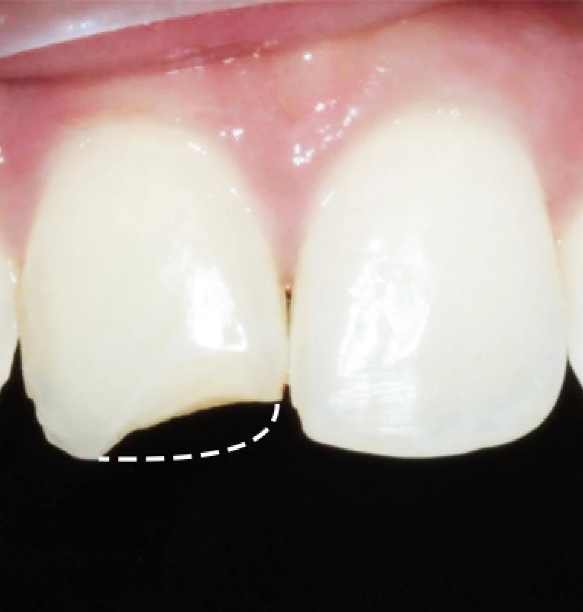 Teeth after bonding procedure at Warsaw Dental Center