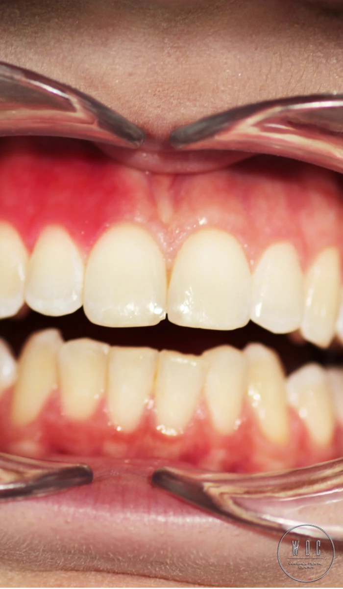 The woman is performing her healthy gums with finger after treatment at Warsaw Dental Center