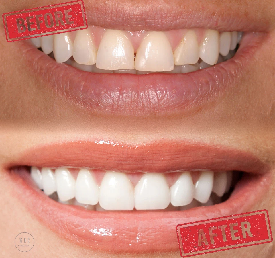 before and after dental bonding