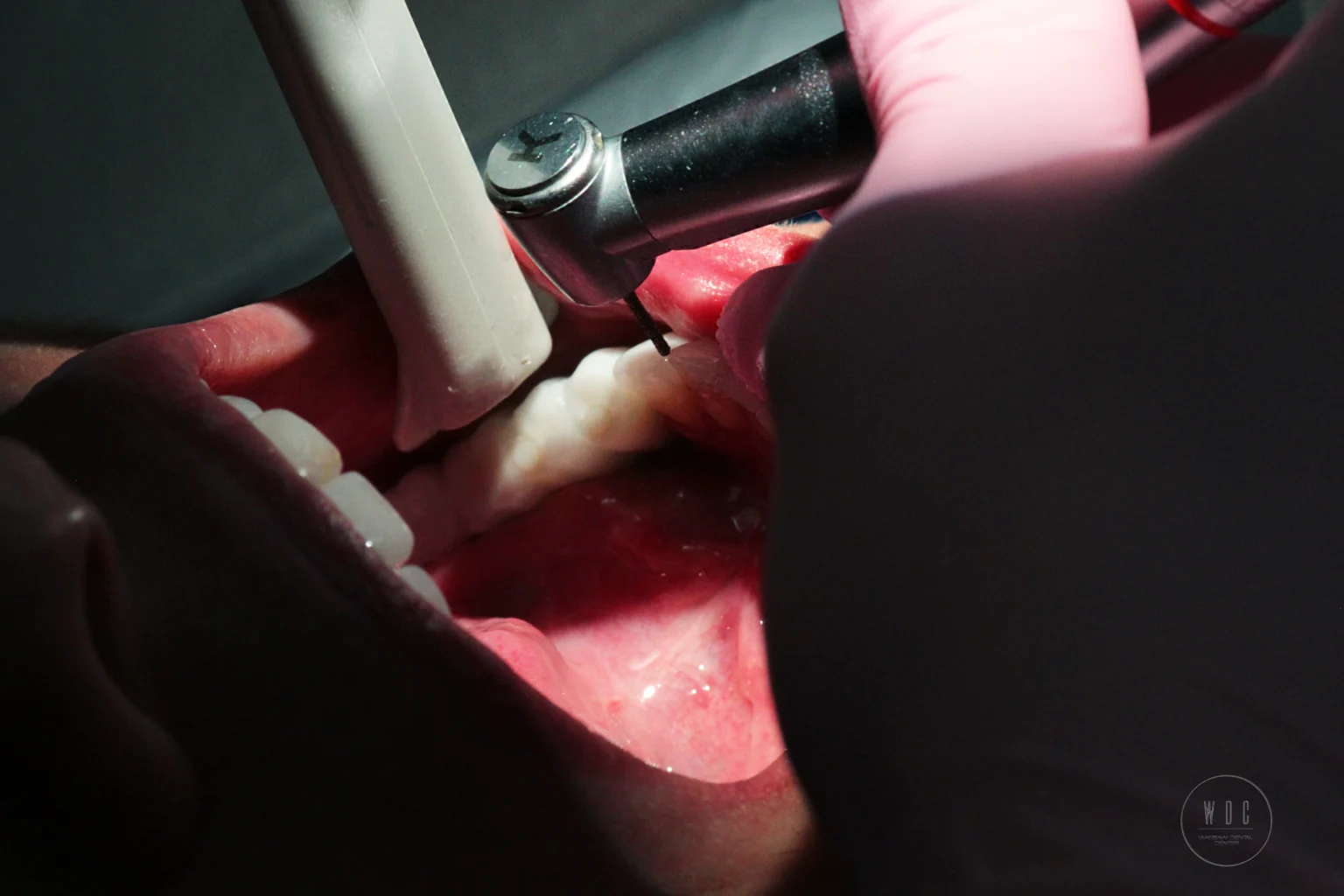 The process of root canal treatment