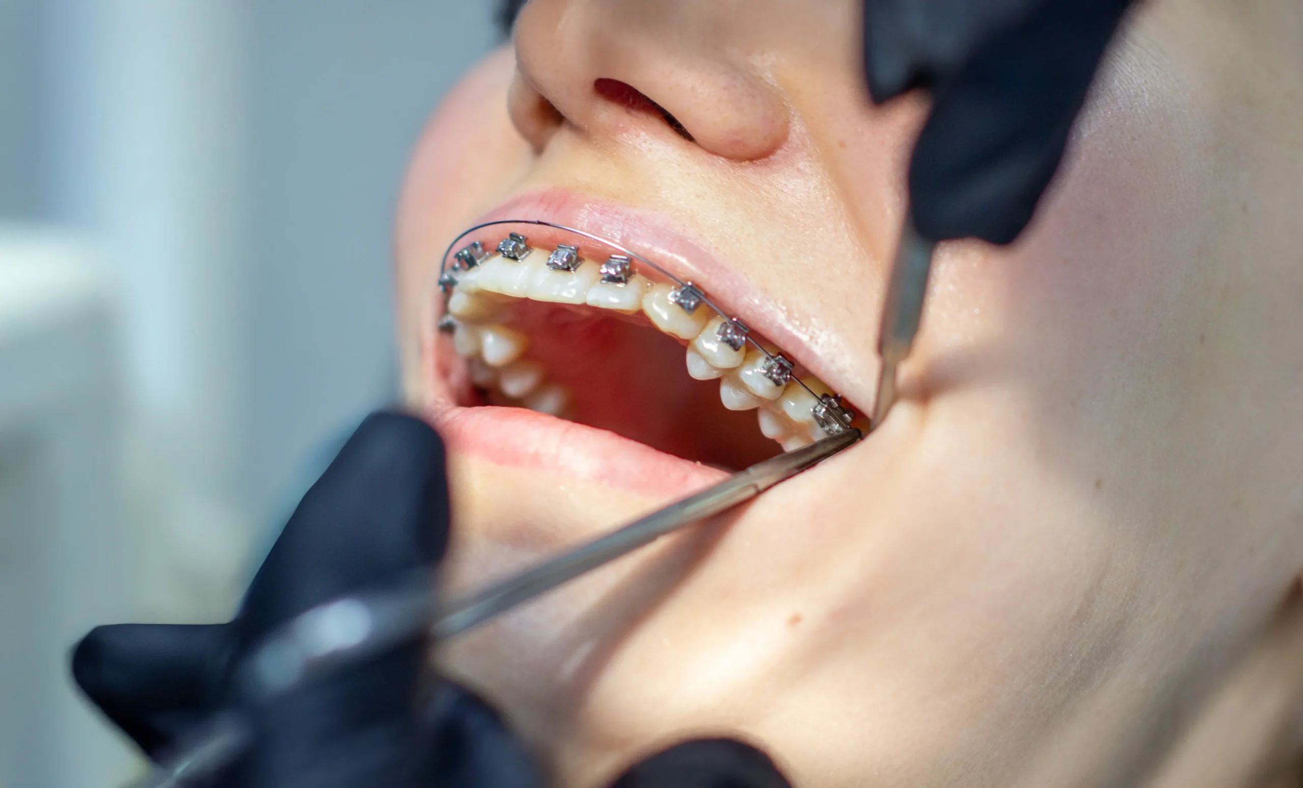 changing the orthodontic arch during a check-up