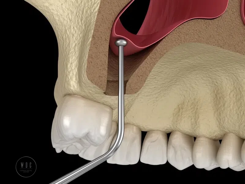 Sinus lift in Warsaw