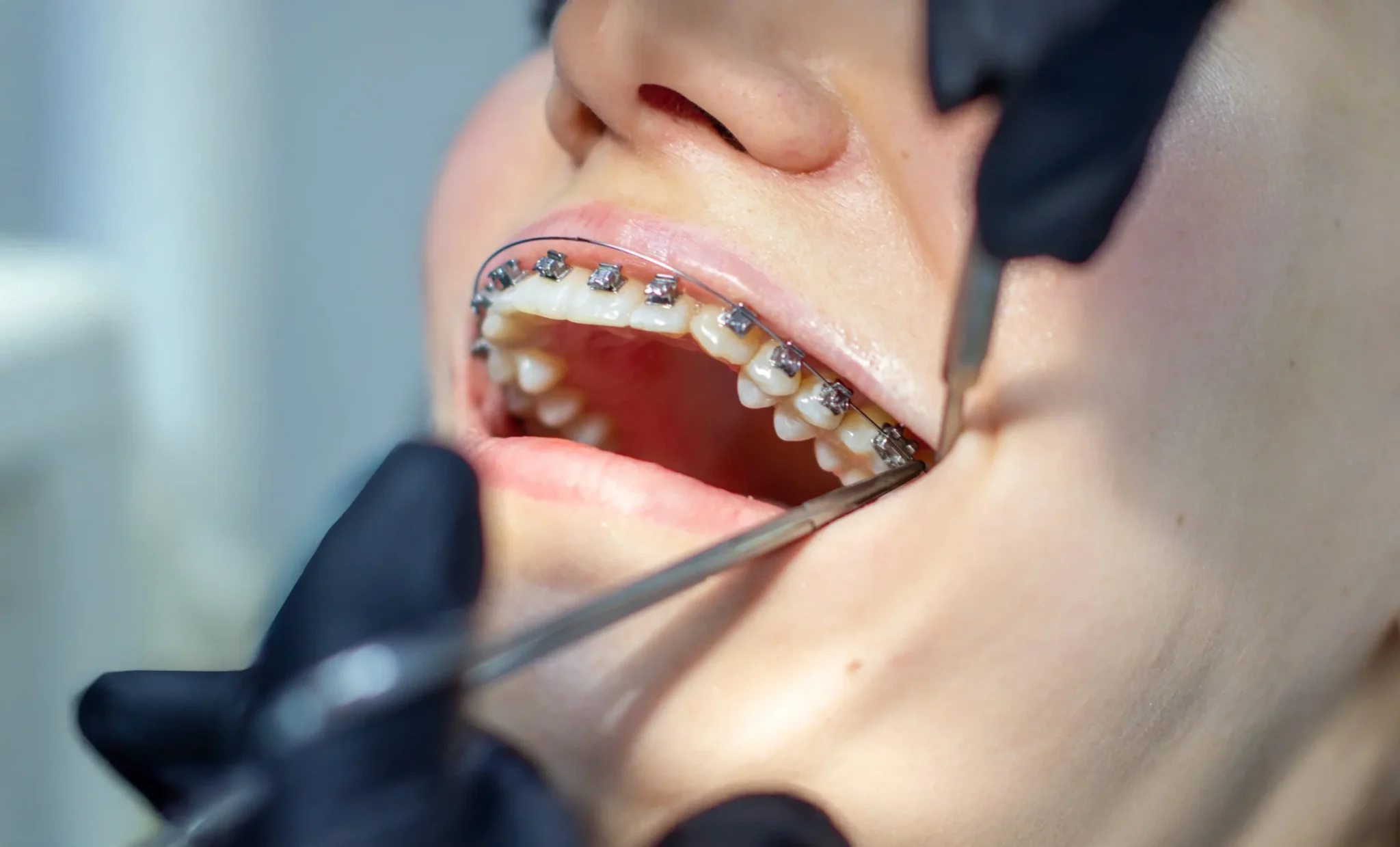 Jak uratowaliśmy młody uśmiech – leczenie inwazyjnej resorpcji szyjkowej u 20-letniej pacjentki Prawdziwa historia kliniczna dr Urszuli Leończak, endodontki w Warsaw Dental Center