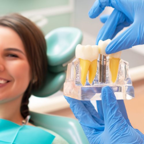 Dental implant model in modern clinic: showing teeth implantation and crown, healthy teeth treatments.