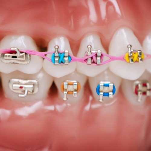 From Bite to Smile: The Role of Orthodontic Elastics in Treatment