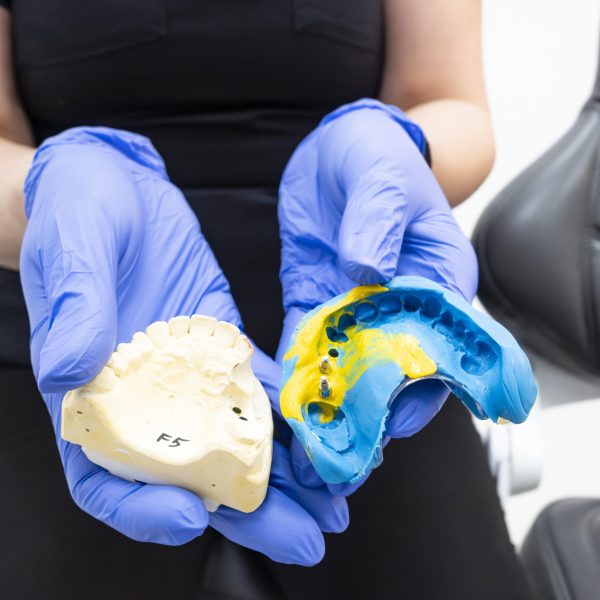 Benefits of choosing dental implants