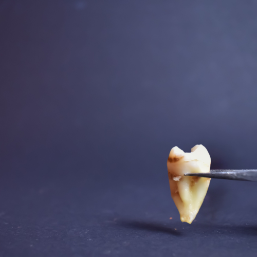 Ruszający się ząb – przyczyny i skuteczne leczenie
