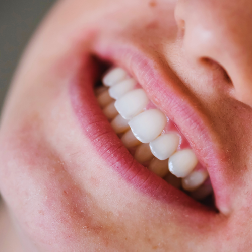 Teeth sandblasting – a path to a healthy and beautiful smile