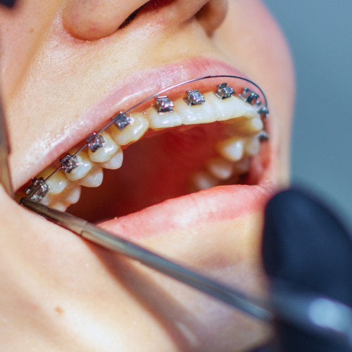 How does the process of removing orthodontic braces proceed?