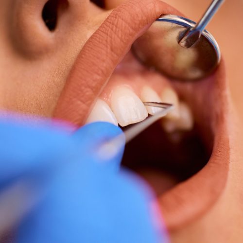 Close up of woman during dental procedure at dentist's office.