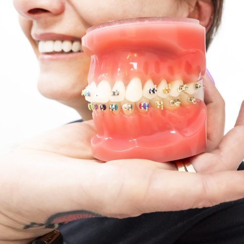 Założenie aparatu ortodontycznego z licówkami – Czy to możliwe?