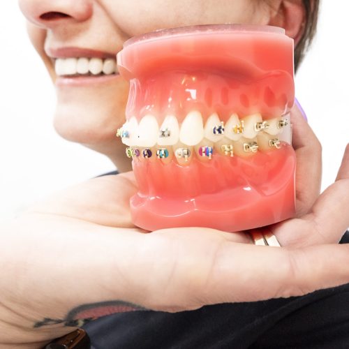 Getting braces with veneers – Is it possible?