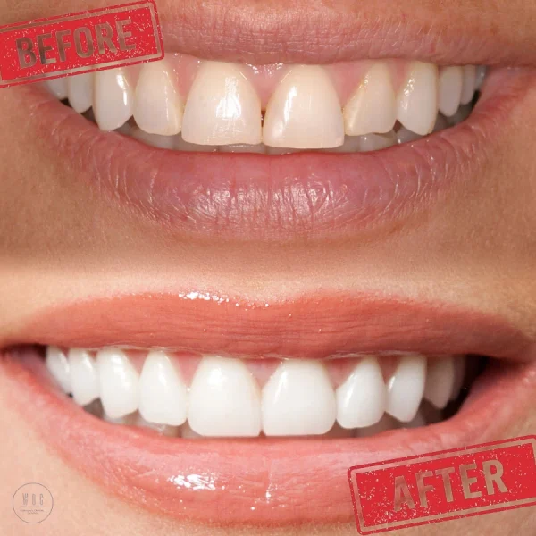 before and after dental bonding