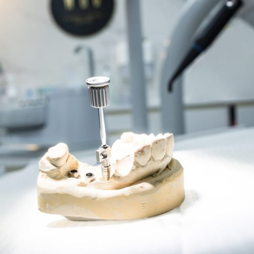 Jak długo właściwie trwa gojenie po wszczepieniu implantu dentystycznego?