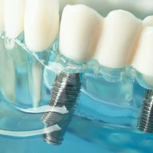 When can an implant be placed after a tooth extraction?