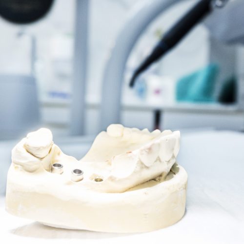 Jak złagodzić stan zapalny po założeniu implantu zęba?