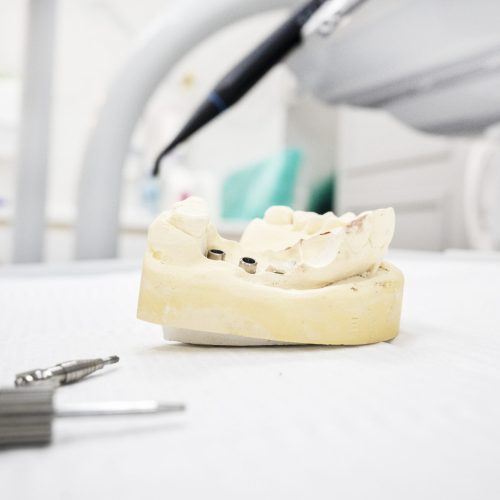 What is periimplantitis and do dental implants need to be replaced?