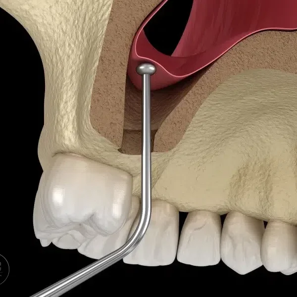 Podniesienie zatoki szczękowej(sinus lift) w Warszawie