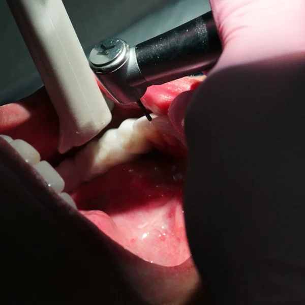 The process of root canal treatment