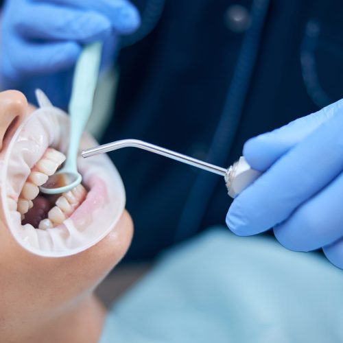 Top view of female lying in dental chair while male doctor is putting filling for her with tools