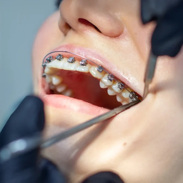 changing the orthodontic arch during a check-up